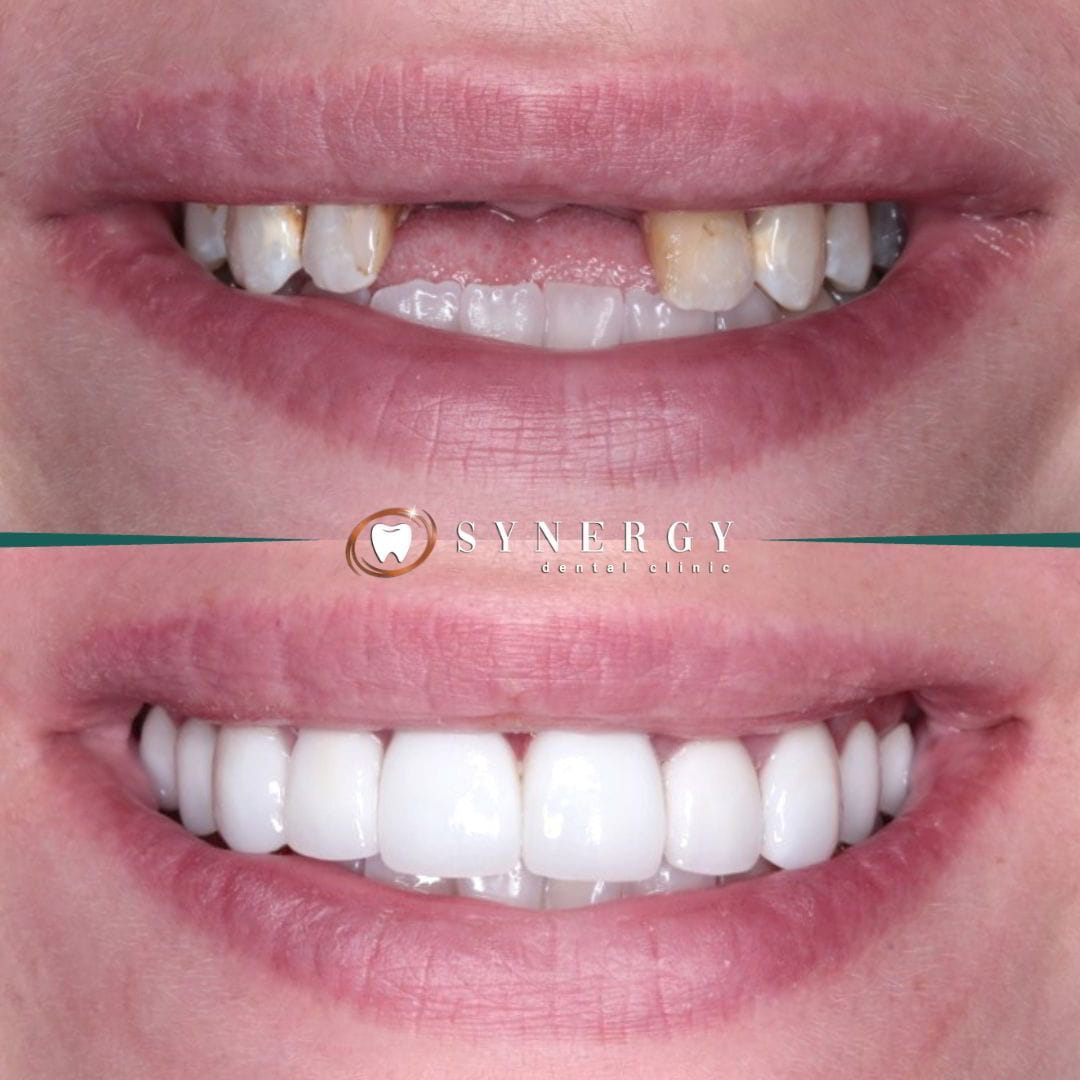 Dr. Zuber Bagasi – Synergy Blackpool – Single implant 13