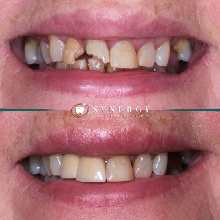 Dr. Zuber Bagasi – Synergy Blackpool – Single implant