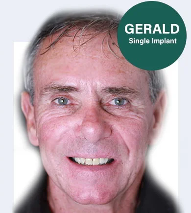 Gerald-single dental implant