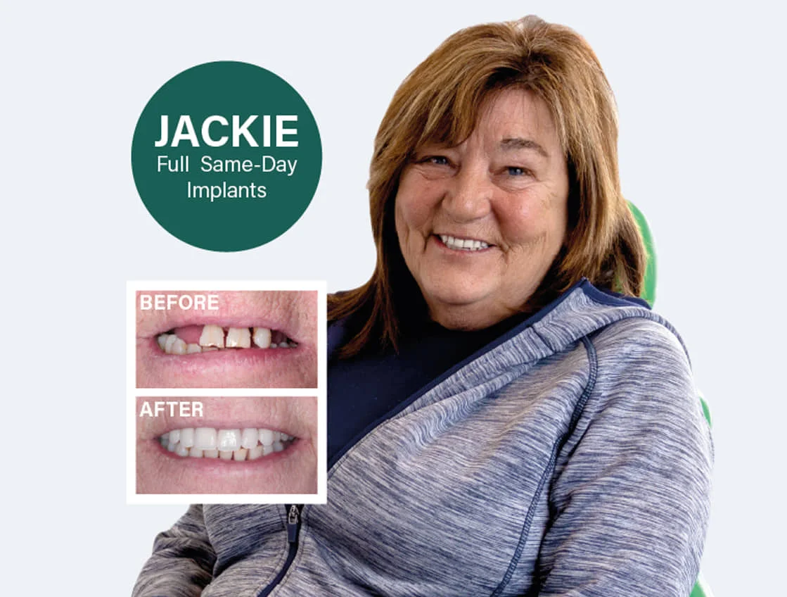 Same-Day-Implants-Jackie