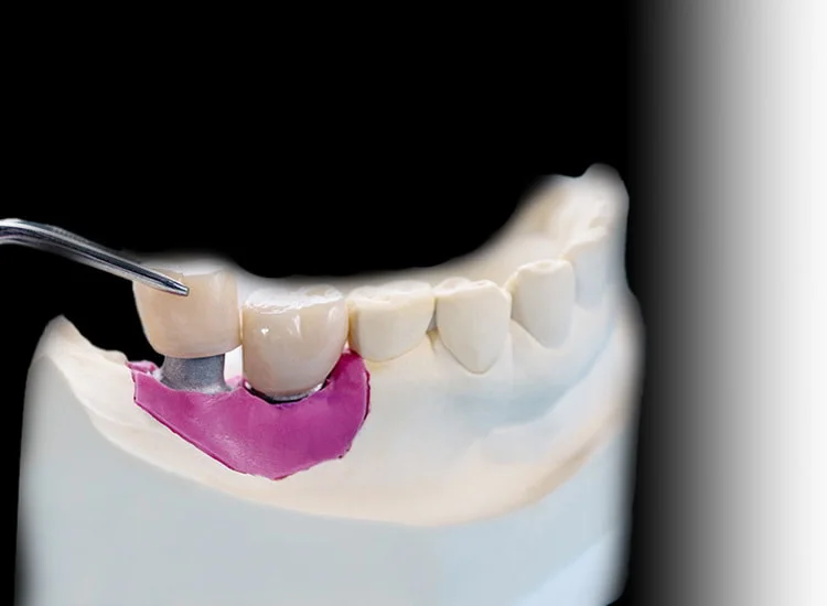 Single dental implant 