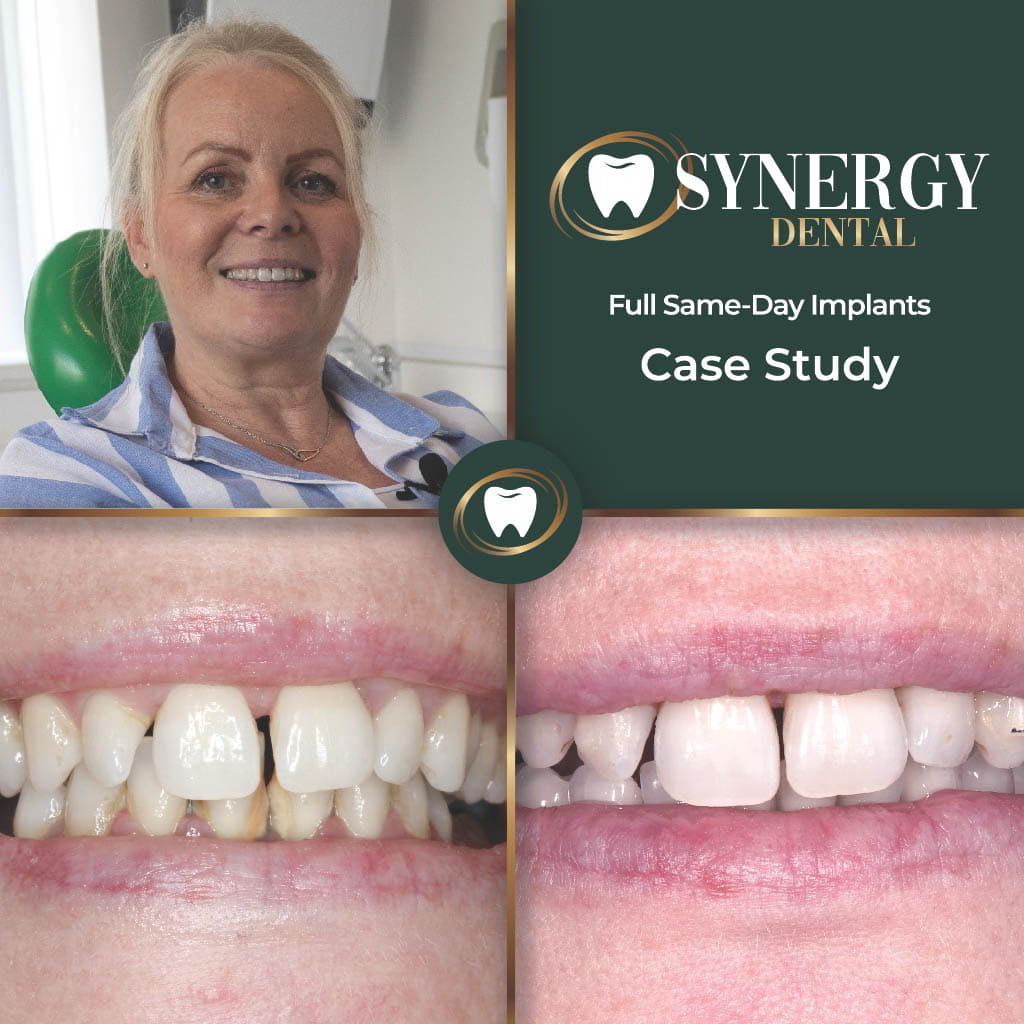 Fiona L FA Implants6789098