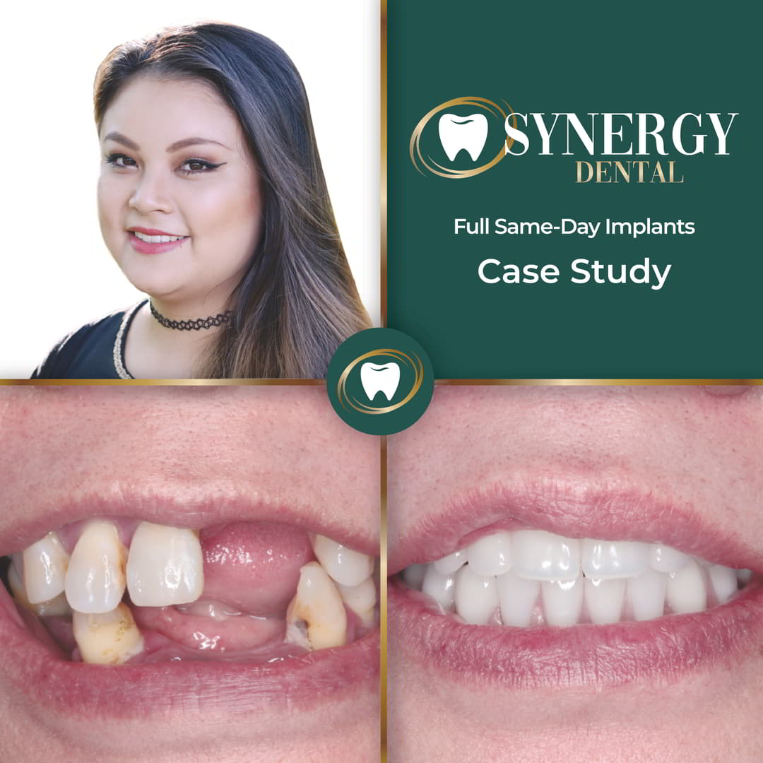 A.Riches FA Implants Case Study78996