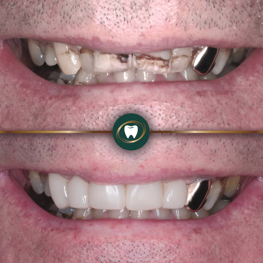AV. Composite Bonding4465434
