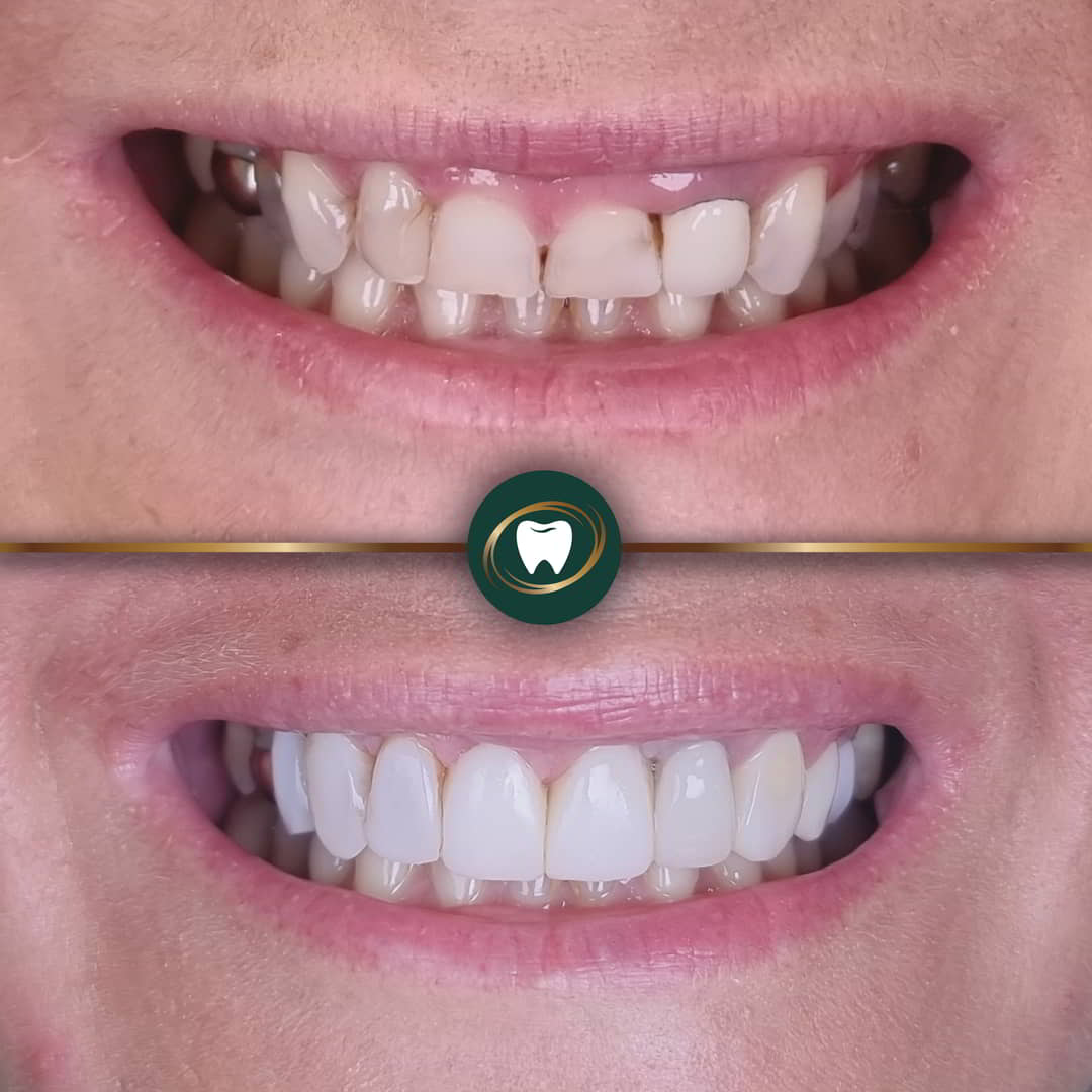 KR. Composite Bonding233443