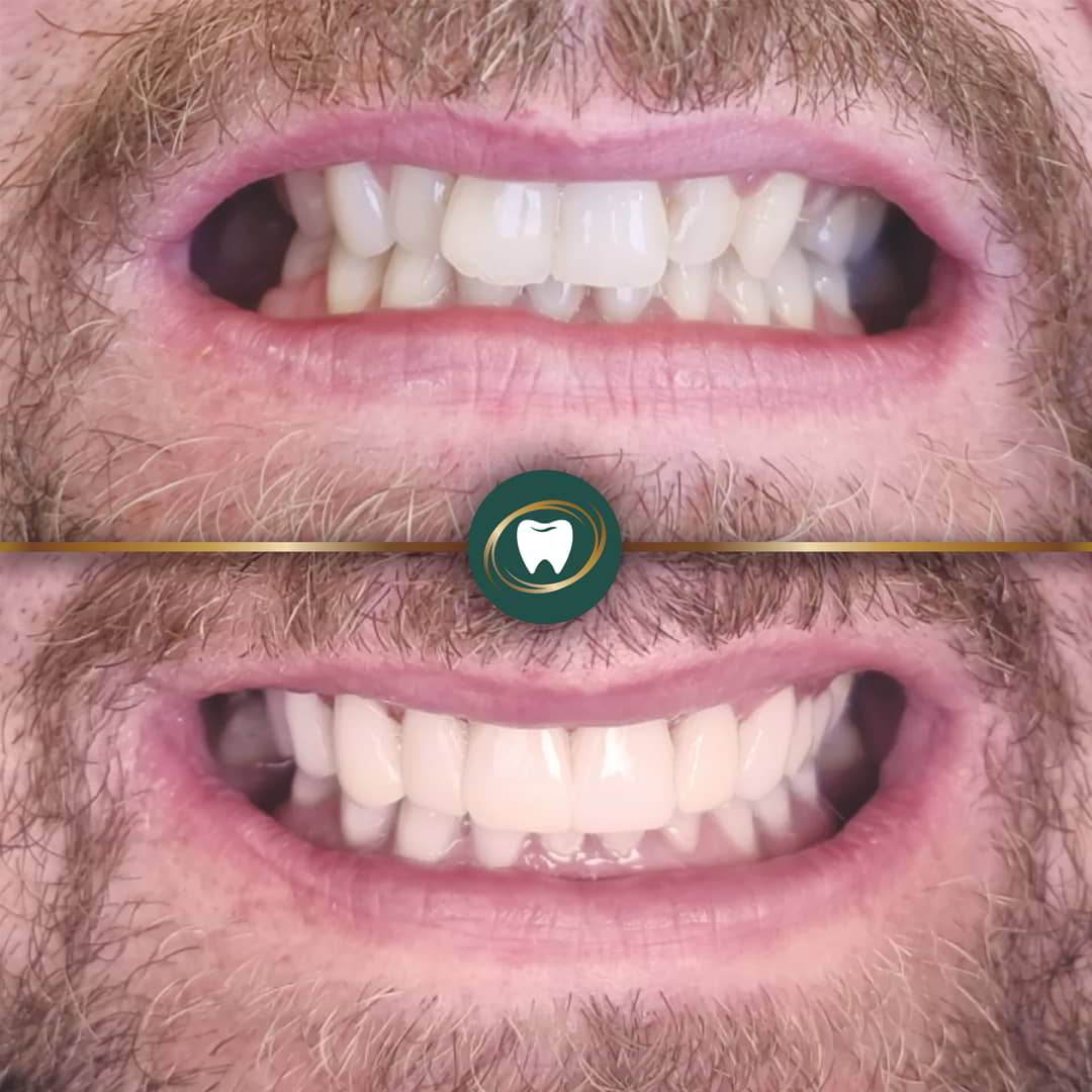 KR. Composite Bonding24423