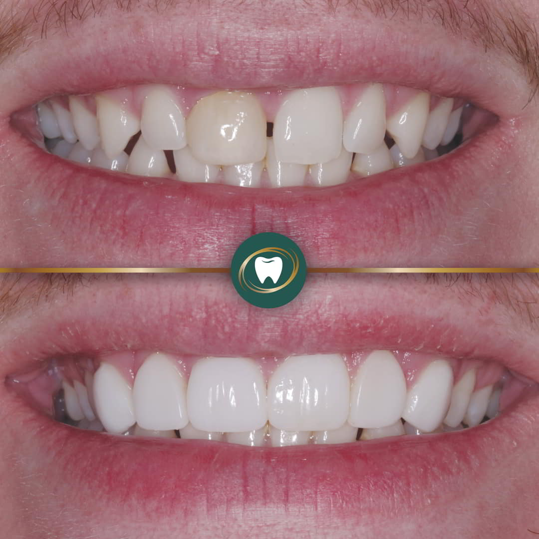 MA. Composite Bonding.AD