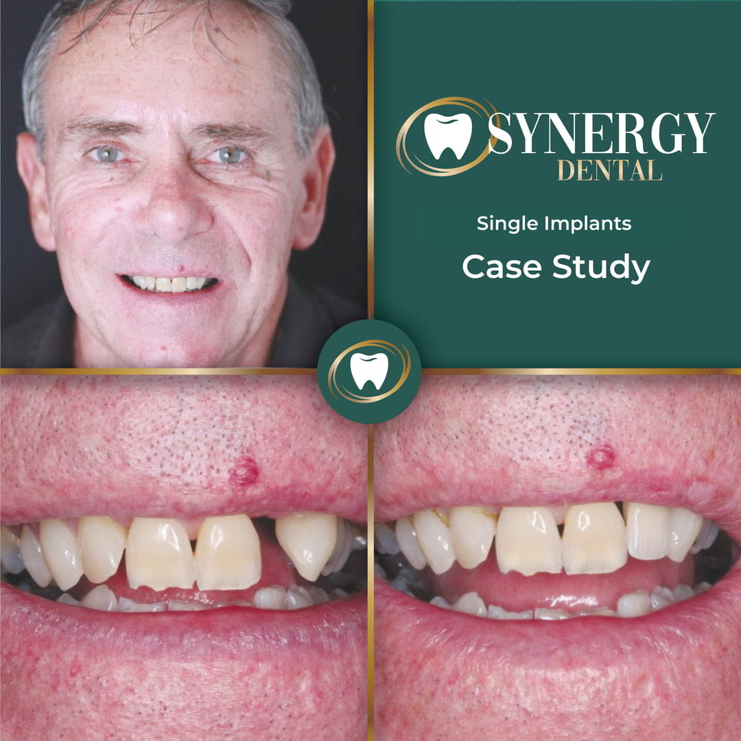 ZB. Dental Implants 56789876