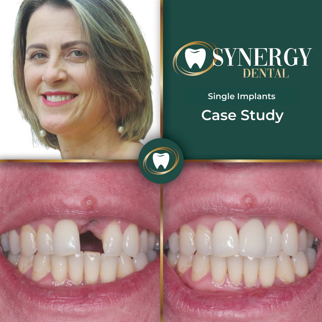 ZB. Dental Implants5628