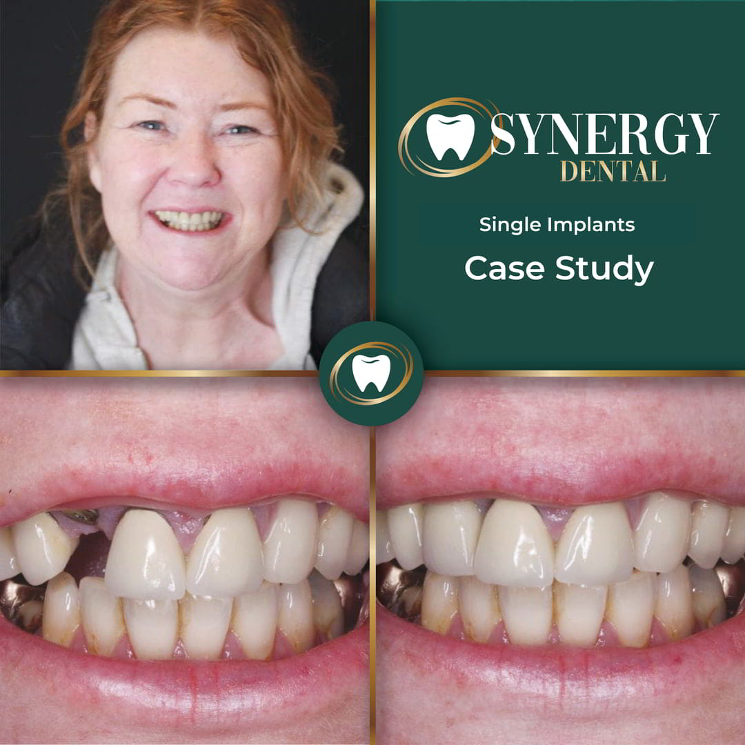 ZB. Dental Implants88855