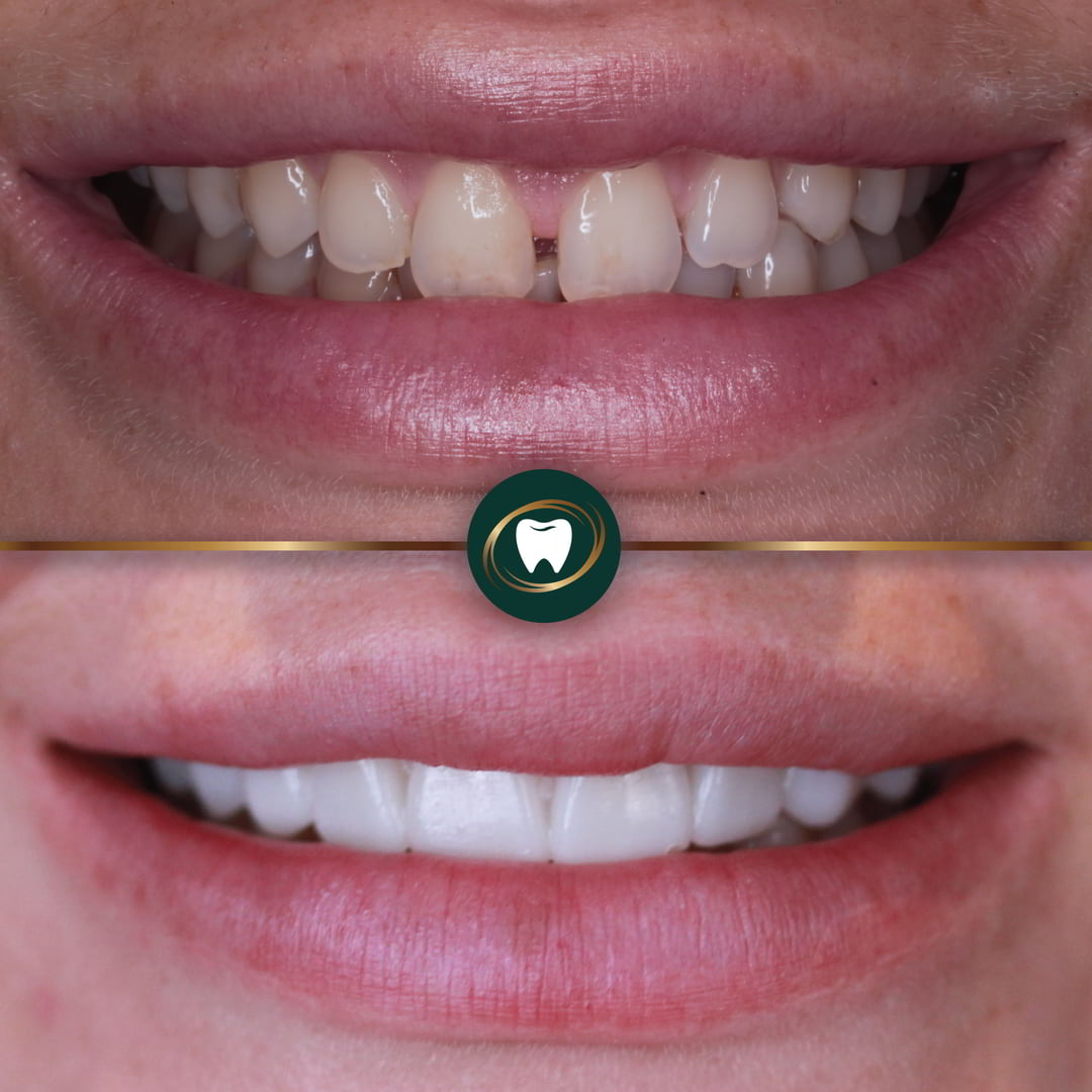 ZB. Composite Veneers. 5553