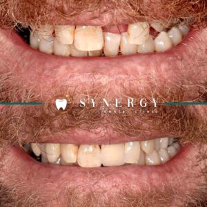 Single dental implant - zuber bagasi