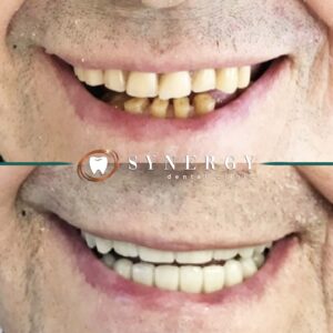 Copy of Satwinder - Blackpool - 14_B&A 7Implant