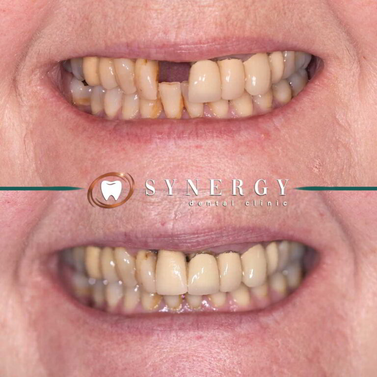 Dr. Zuber Bagasi - Implant SMALL
