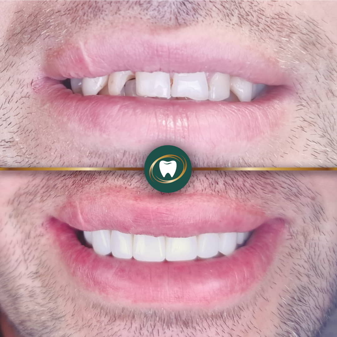 KR. Composite Bonding.8768