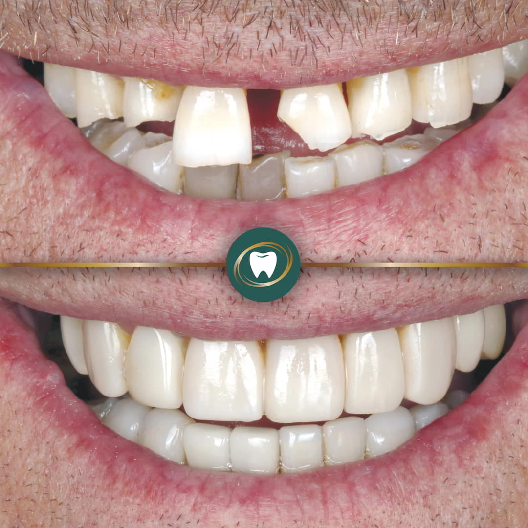MP. Composite Bonding.LD