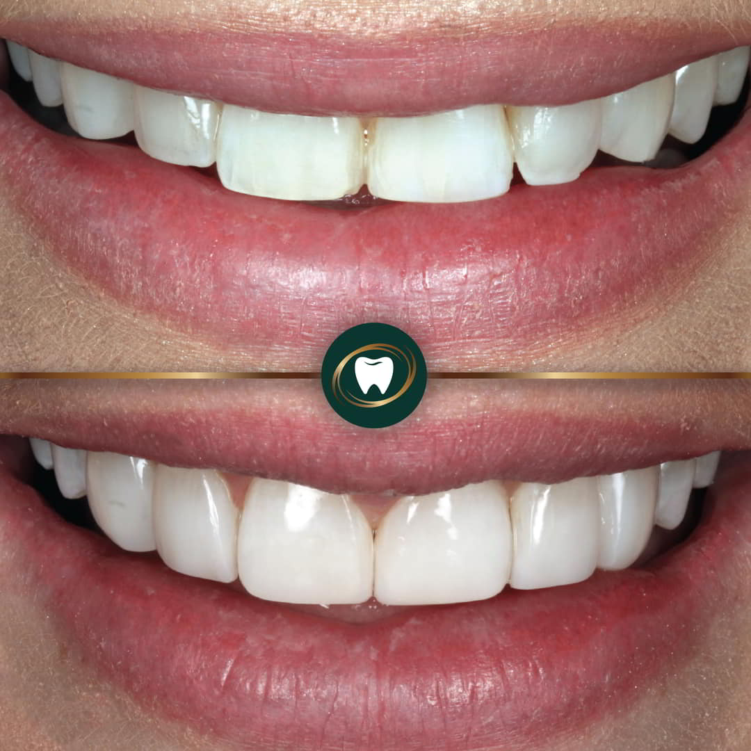 MP. Composite Bonding.NC
