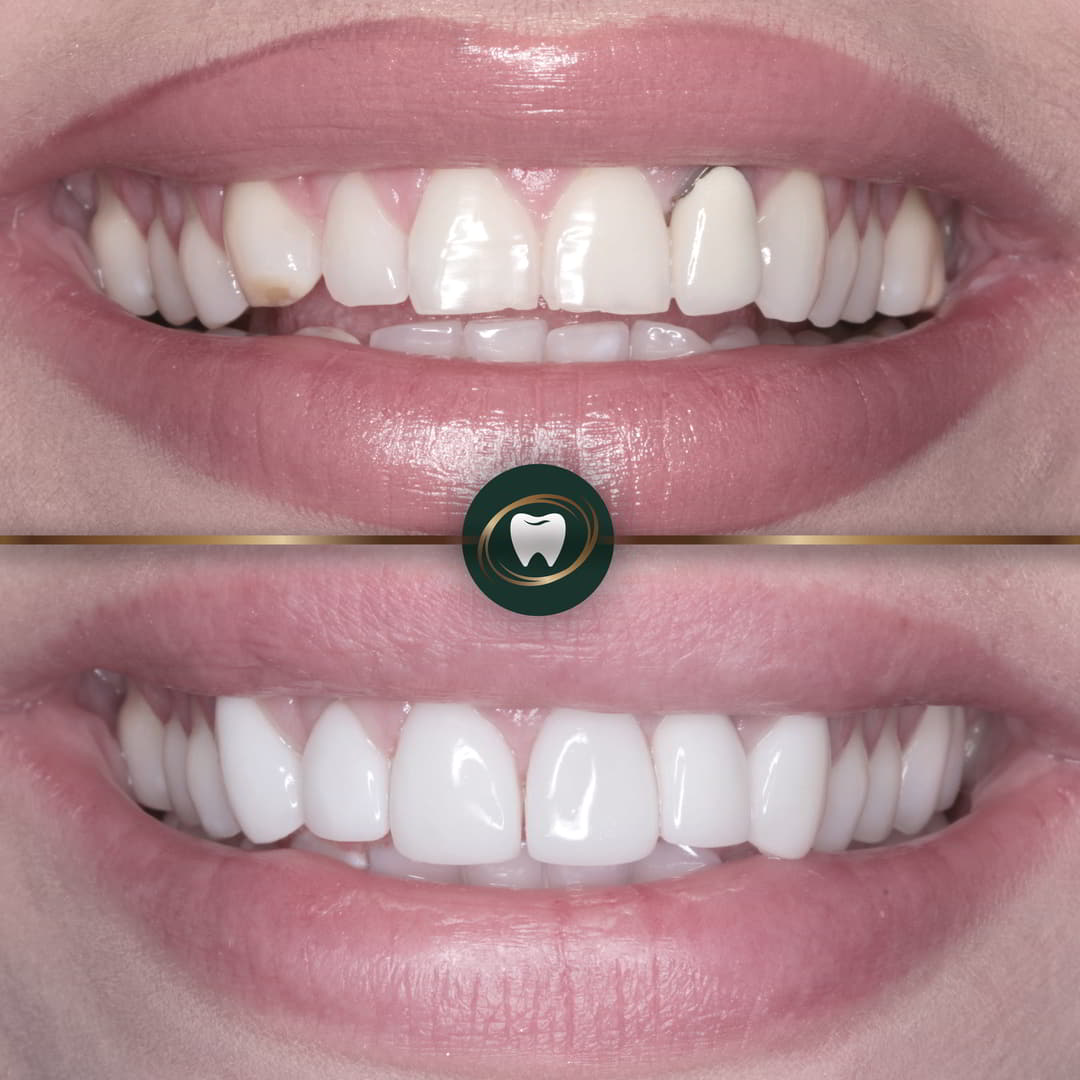 ZB. Smile MakeoverCR3334