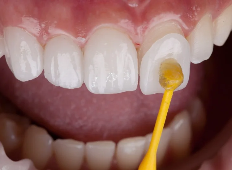 Dental Veneers Fitting Procedure