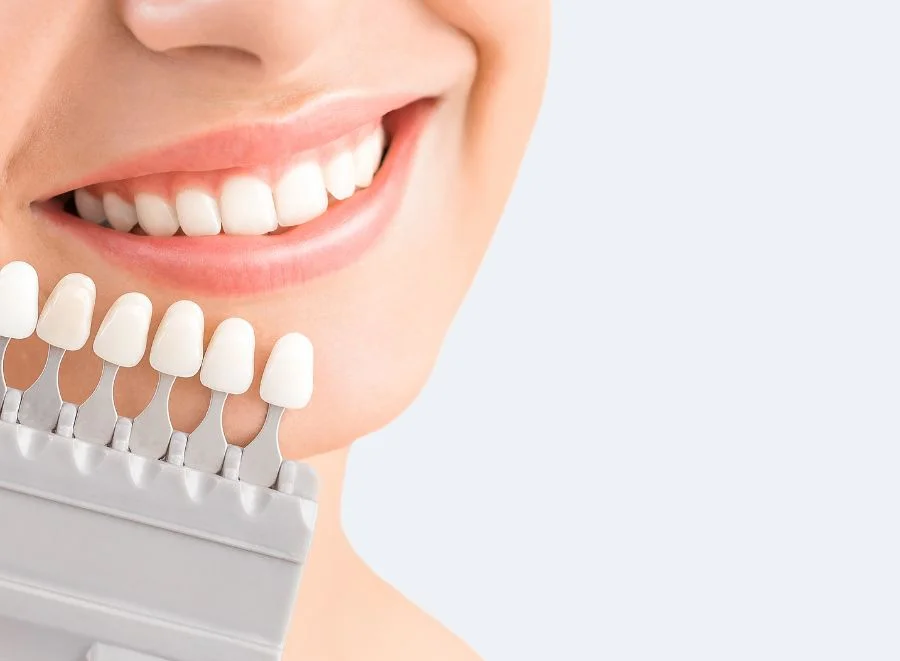 What is teeth whitening