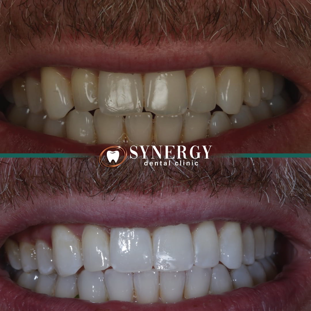 Before & After Template-ubayda
