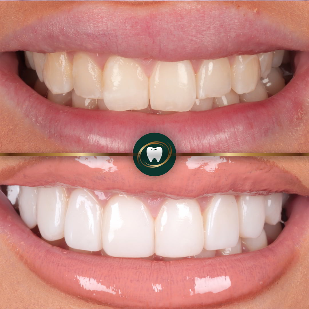 Dr. Rushaine Smith - Composite Veneers