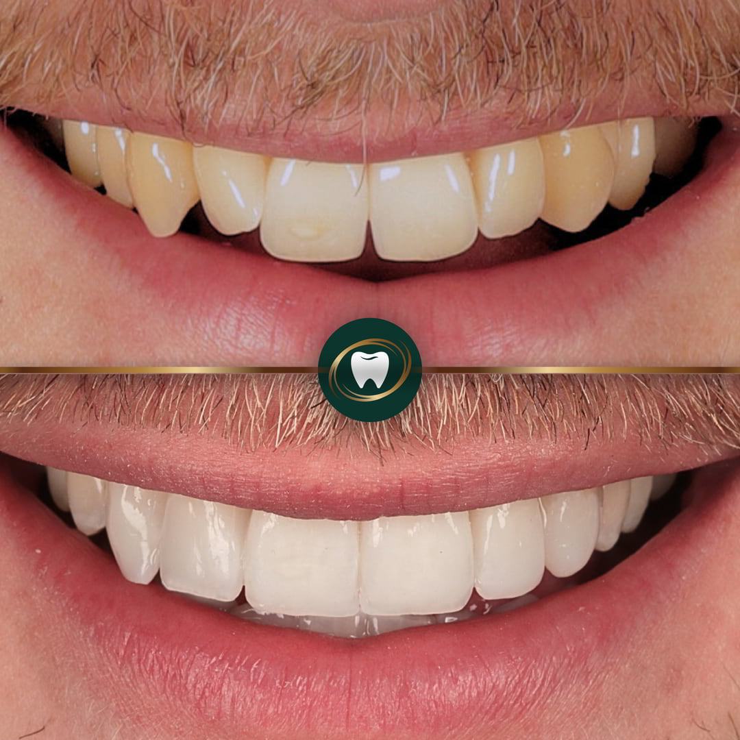 Dr. Rushaine smith - Smile makeover Invisalign and Composite bonding