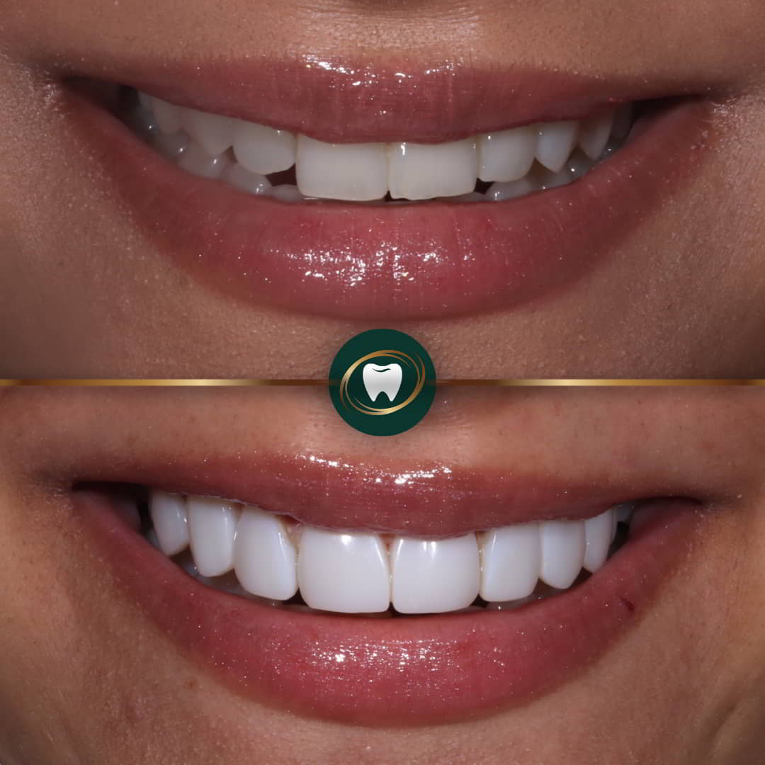 Dr. Zohaib Zaman - Composite Veneers
