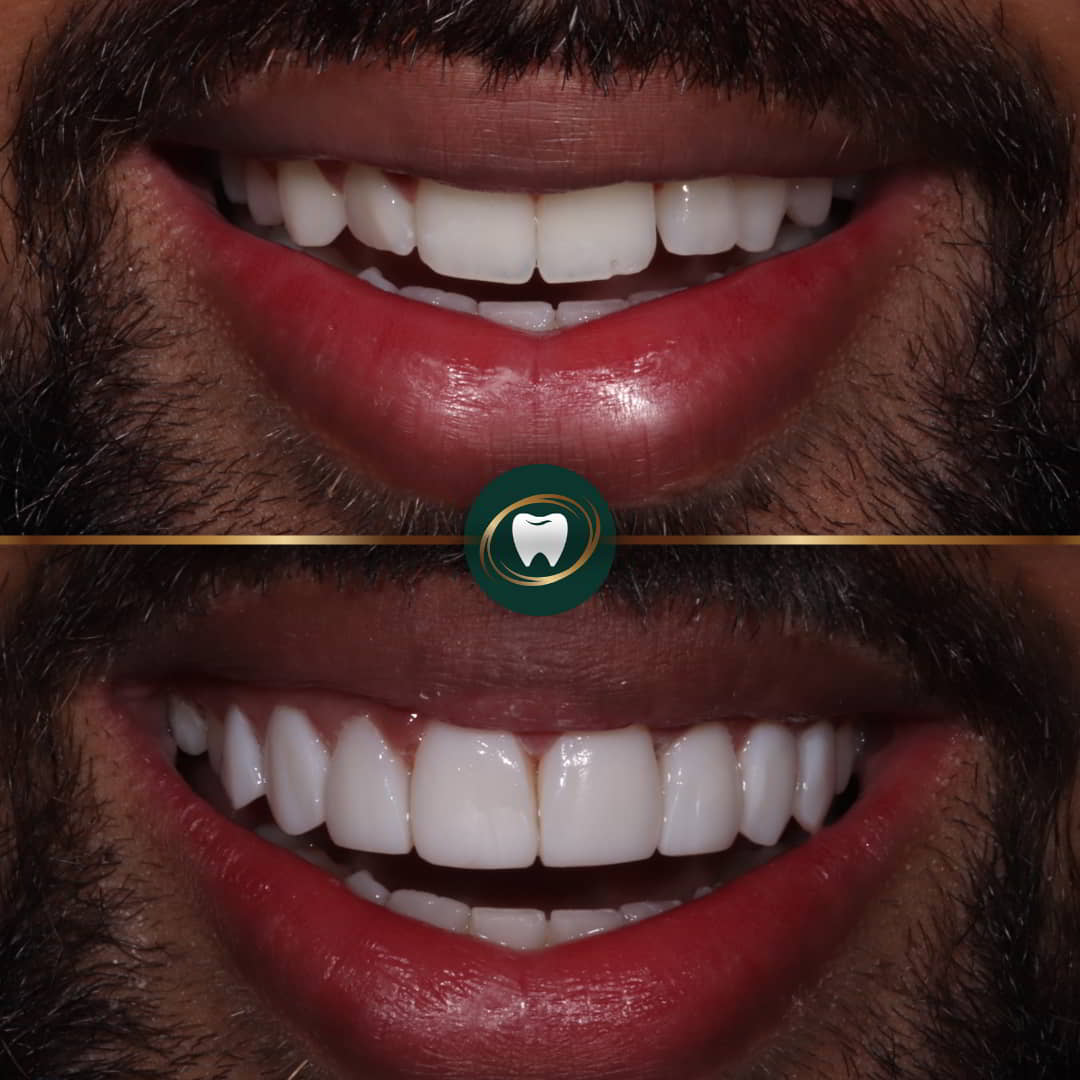 Dr. Zohaib Zaman - Composite bonding 334