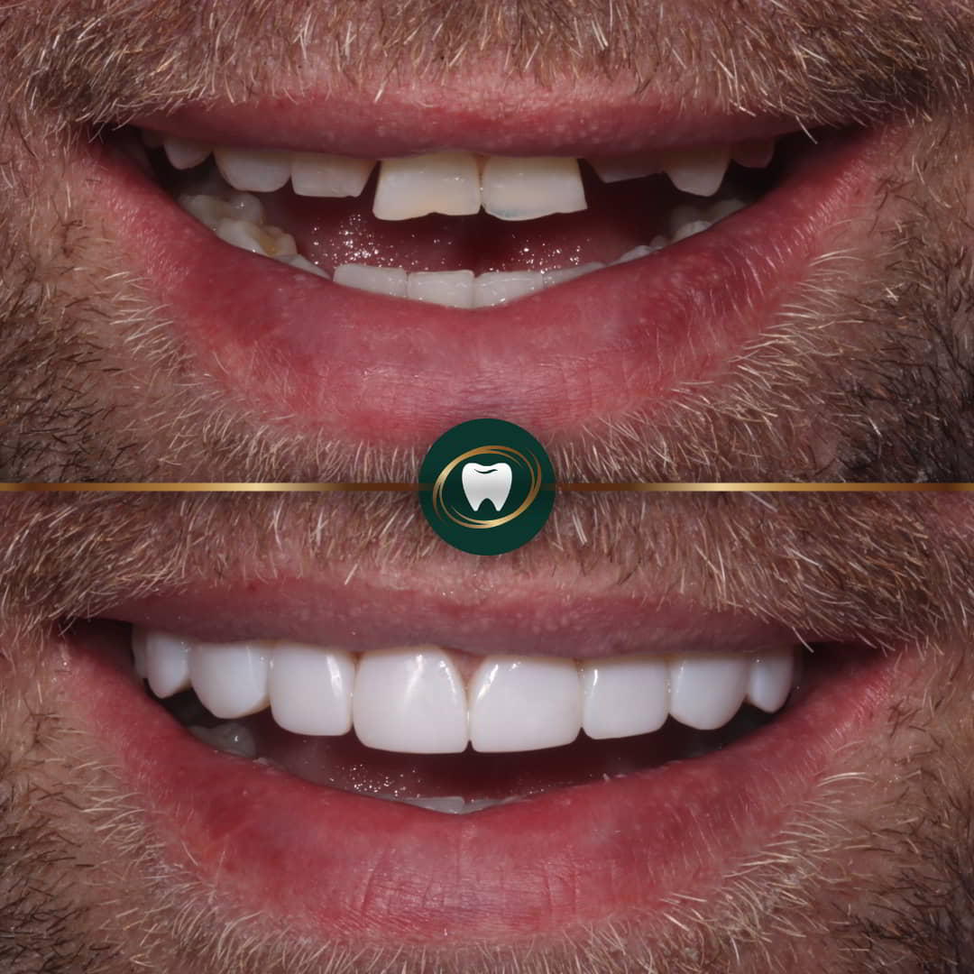 Dr. Zohaib Zaman - Composite bonding case