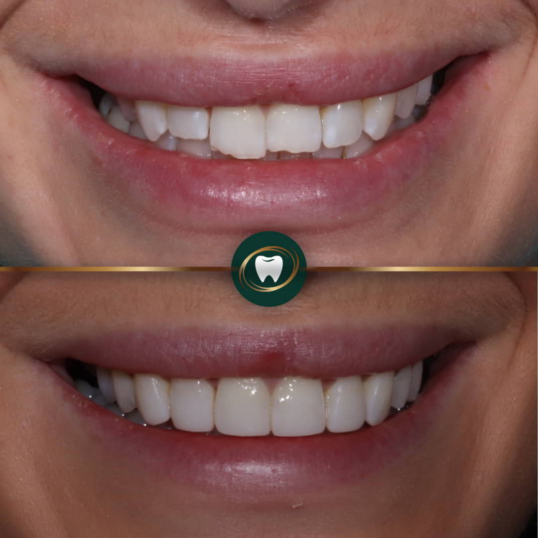 Dr. Zohaib Zaman Composite veneers 555