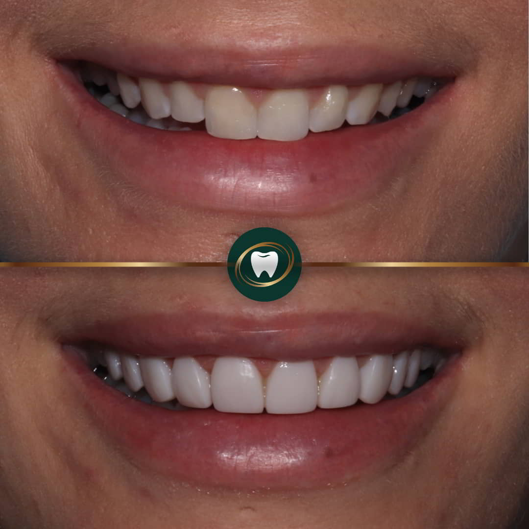 Dr. Zohaib Zaman - composite veneers444