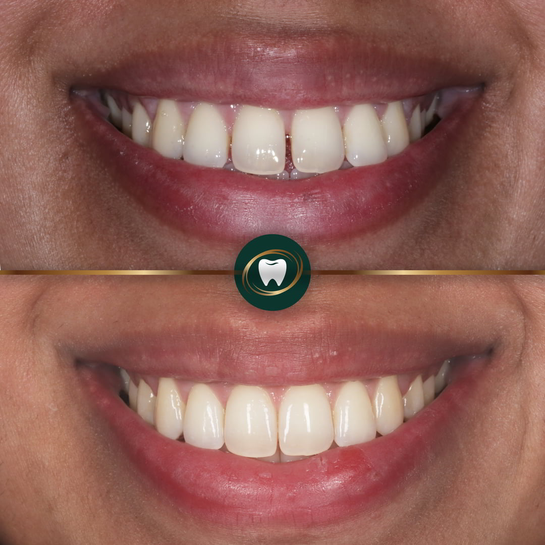 Mahesh Invisalign-01
