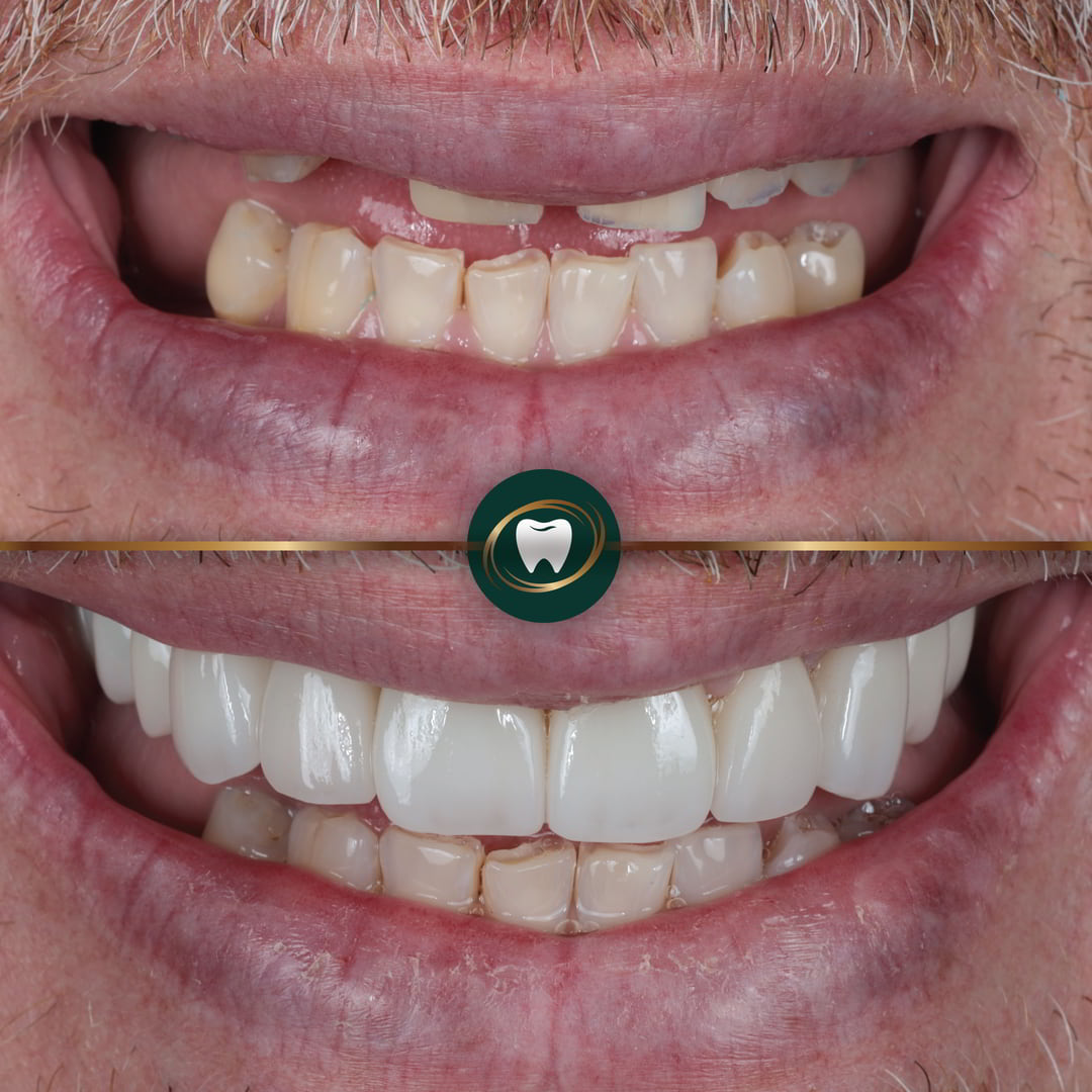Mak Dhinsa Before & After-01