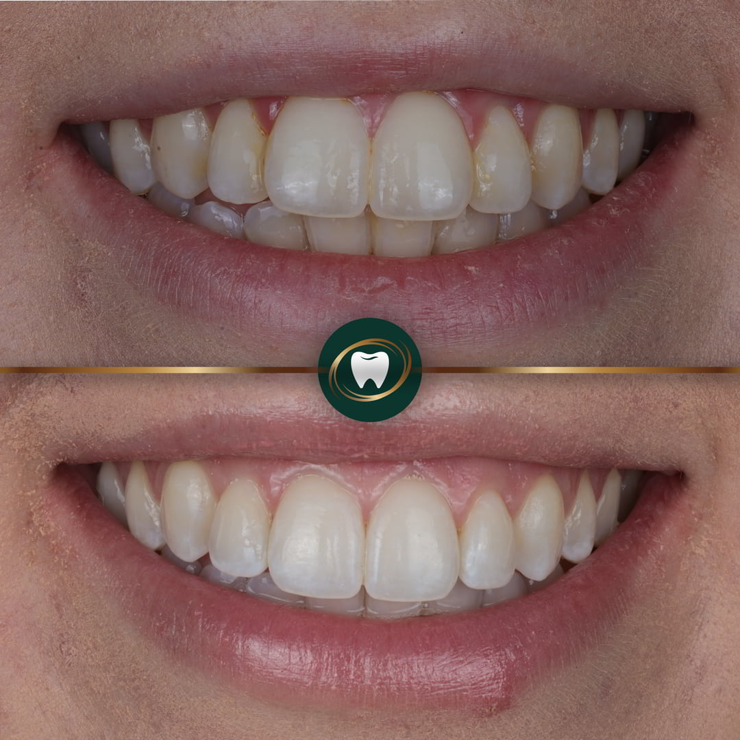 Mak Dhinsa Invisalign-01