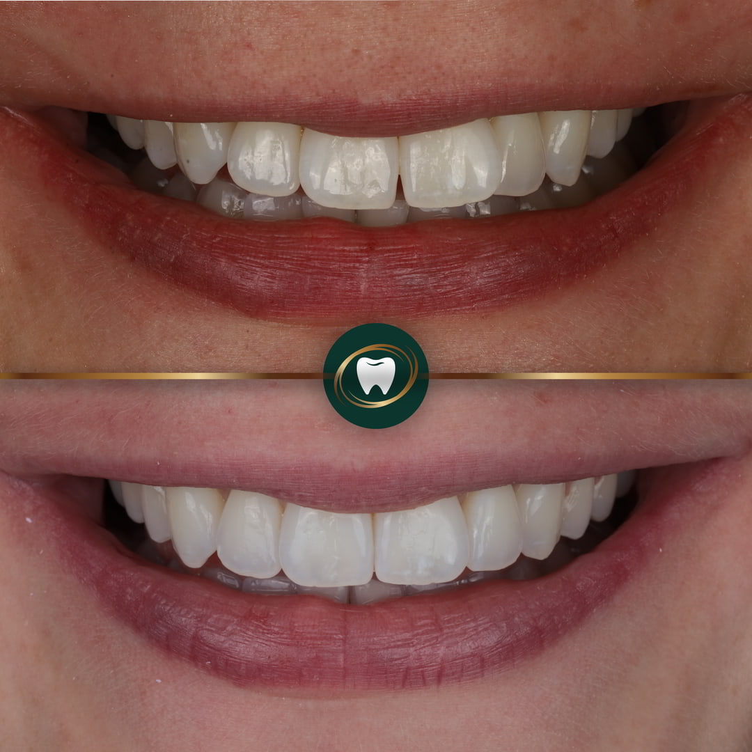 Mak Dhinsa Invisalign 3-01