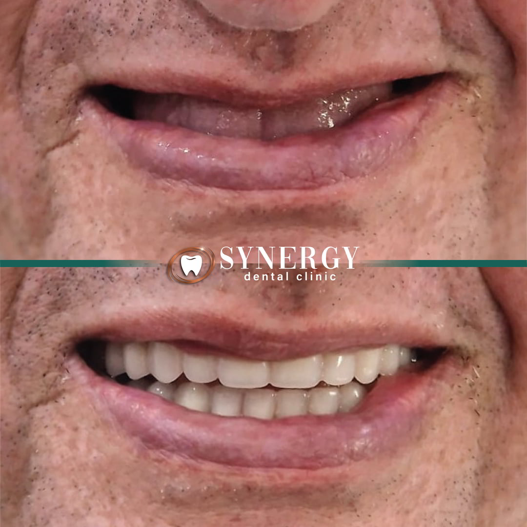 Raza 1-01 Dentures
