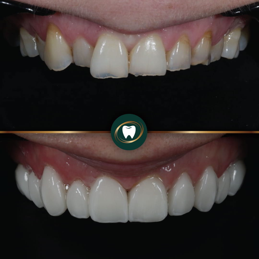 Smile Gallery Thumbnails UA 22221
