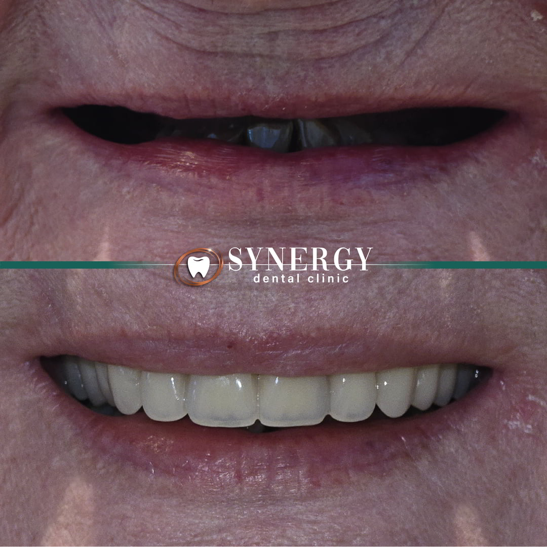 raza dentures
